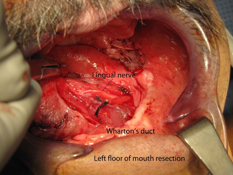 03ductoplasty%20c.jpg