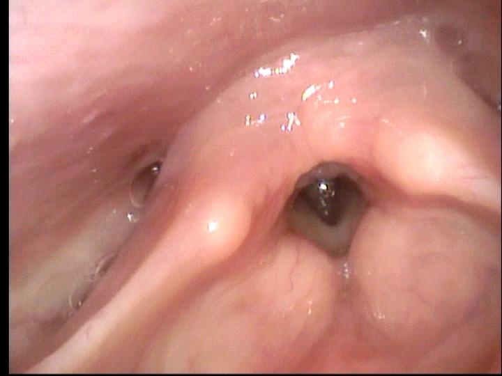 10-21-20 appearance of larynx