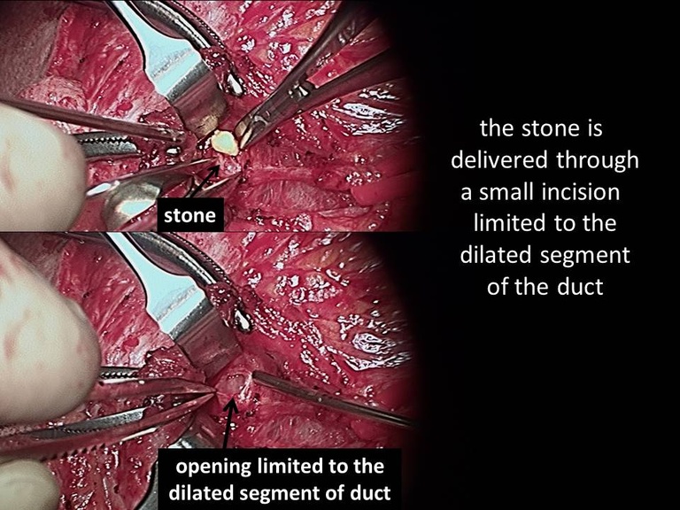 04%20open%20stone%20removal.jpg