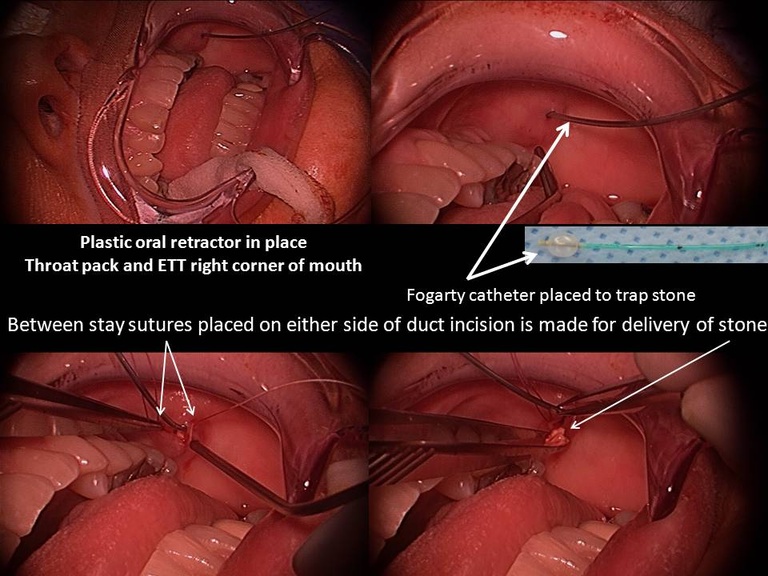 040 anterior stone removal.jpg