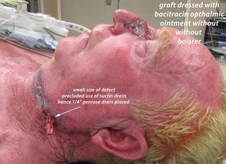 040%20ftsg%20graft%20drain%20secured.jpg