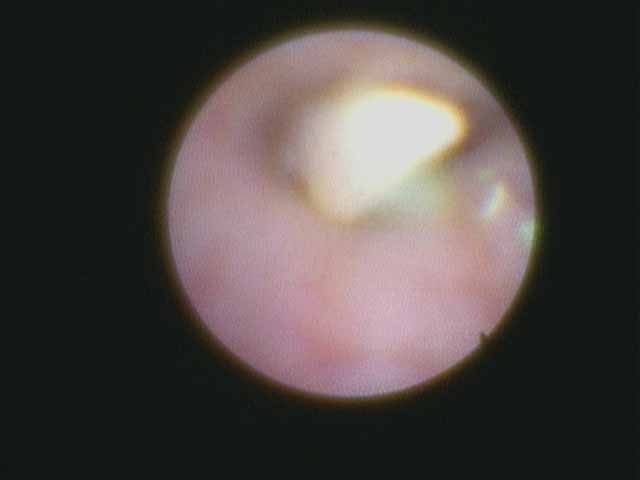 e. View through sialendoscope before gland removal showing mobile stone