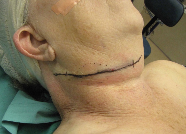 042%202nd%20arch%20excision.jpg