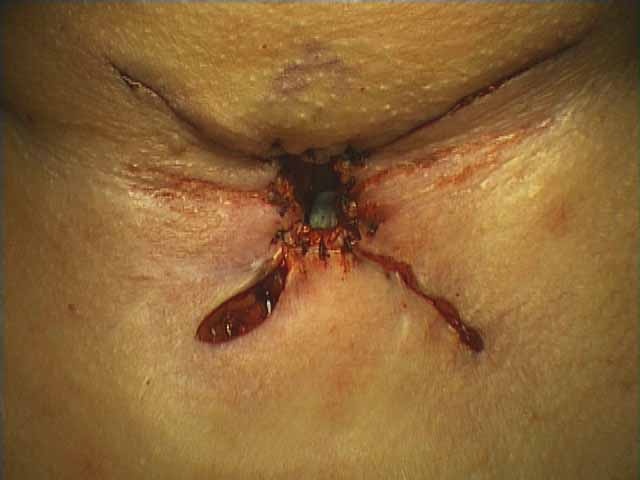 042%20trachstenosis.jpg