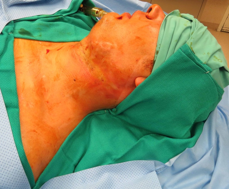 Extended Level I Neck Dissection