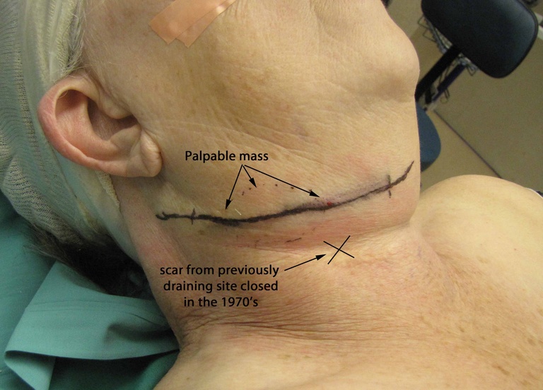 043%202nd%20arch%20excision.jpg