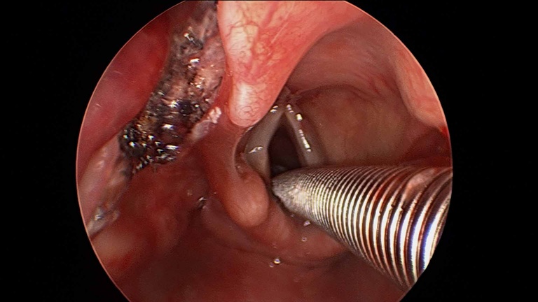 043%20vcyst.jpg