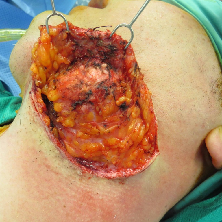 Extended Level I Neck Dissection