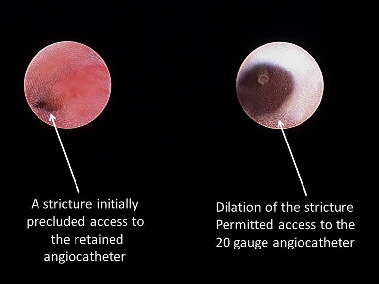 044%20foreing%20body%20sialendoscopy.jpg
