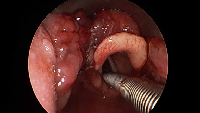 044%20vcyst.jpg