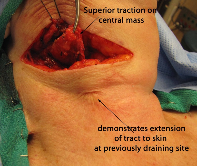 045%202nd%20arch%20excision.jpg