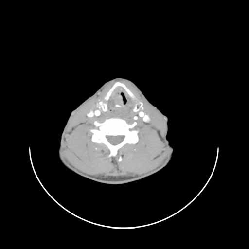 CT imaging demonstrates a large right glottic mass filling paraglottic space