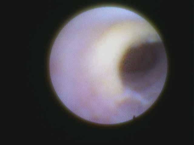 f. View through sialendoscope after gland removal showing stone adherent to wall of duct remnant requiring further resection of duct (see op note below)