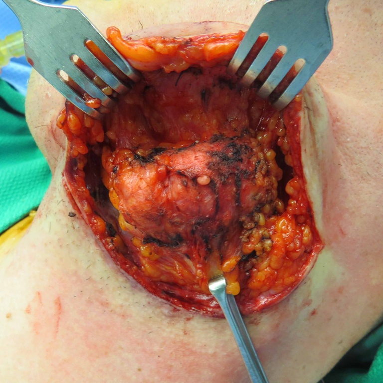 Extended Level I Neck Dissection