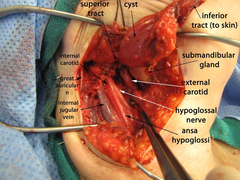 046%202nd%20arch%20excision.jpg