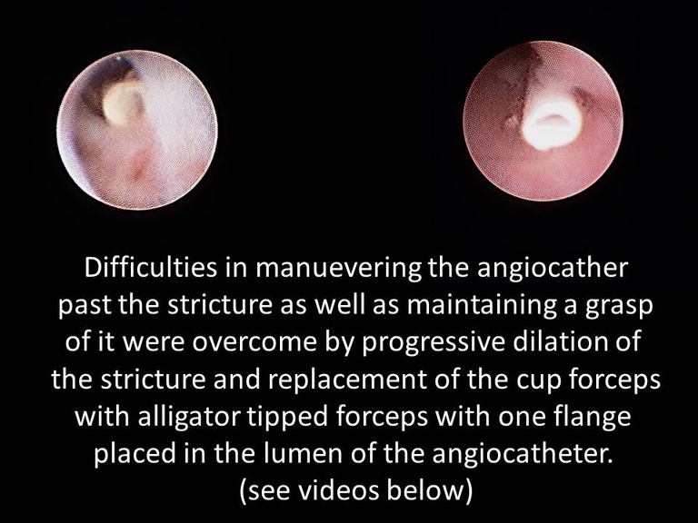 046%20foreing%20body%20sialendoscopy.jpg