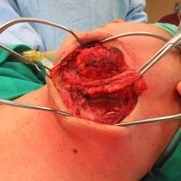 Extended Level I Neck Dissection