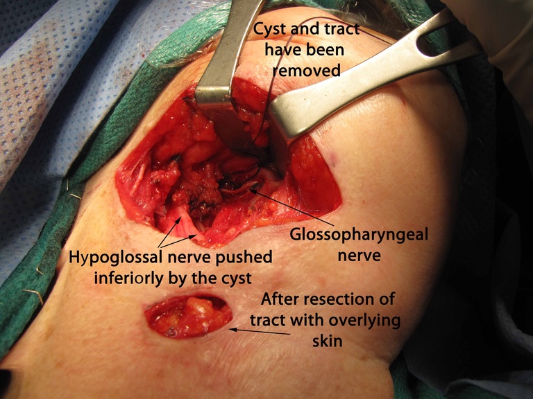 047%202nd%20arch%20excision.jpg