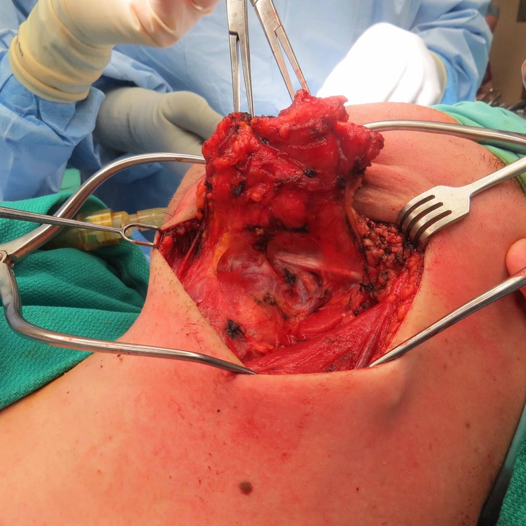 Extended Level I Neck Dissection