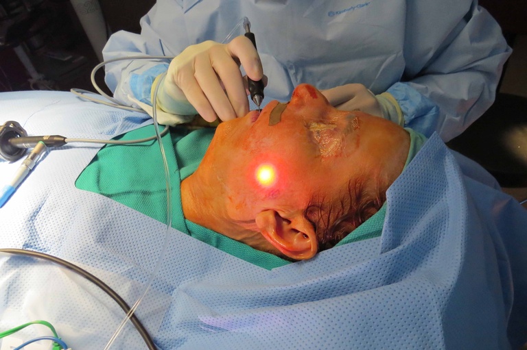 048 initial sialendoscopy.jpg