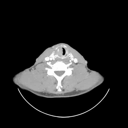 CT imaging identifies subglottic extension