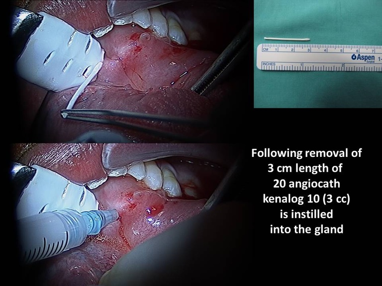 048%20foreign%20body%20sialendoscopy.jpg