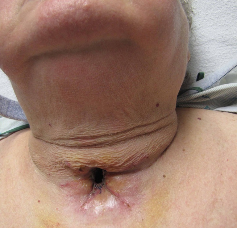 Postoperative Day #5 at time of tracheotomy change from #6 cuffed Shiley to #6 metal Jackson