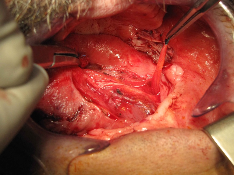 04ductoplasty%20d.jpg