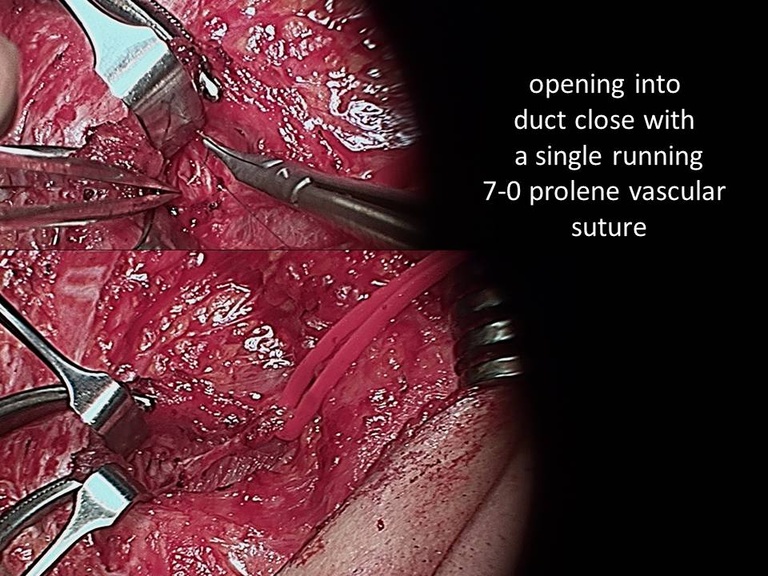 05%20open%20stone%20removal.jpg