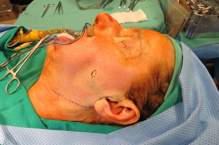 050 preparation for open procedure.jpg
