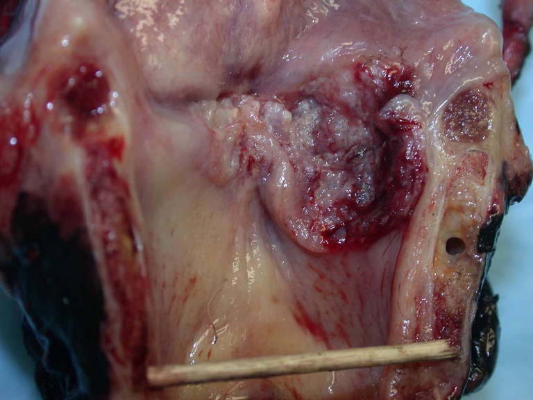 Total laryngectomy specimen showing squamous cell carcinoma involving right vocal cord, anterior commmissure and subglottis