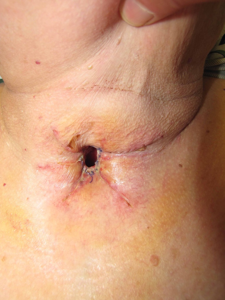 With #6 metal cuffless Jackson tracheotomy good phonation achieved to be improved with use of Passey-Muir valve.