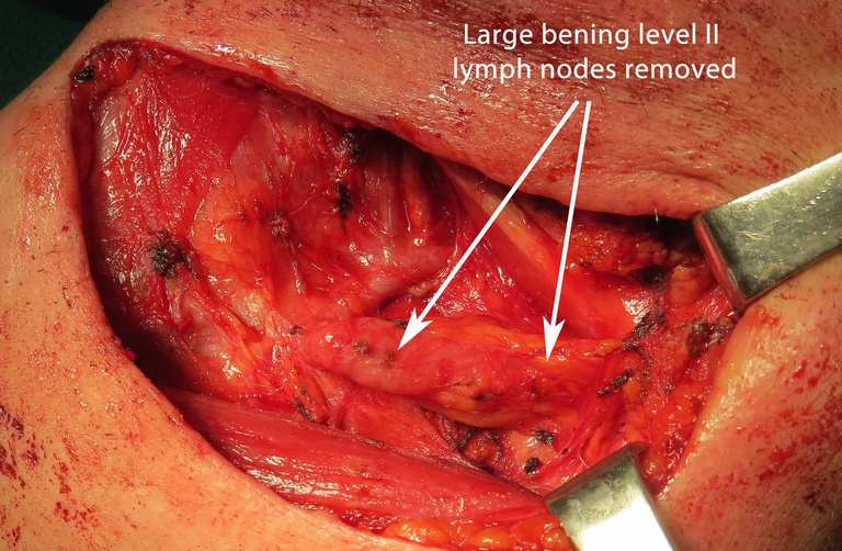 Extended Level I Neck Dissection