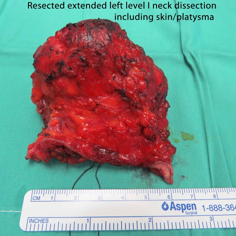 Extended Level I Neck Dissection