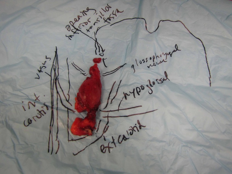 052%202nd%20arch%20excision.jpg