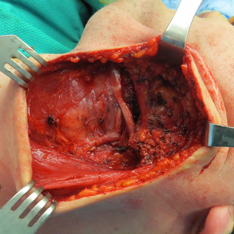 Extended Level I Neck Dissection