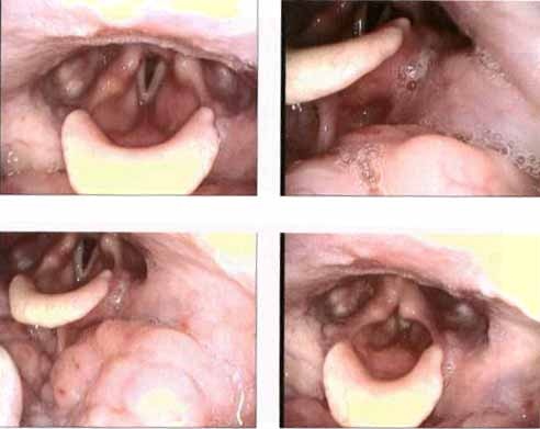 one month postop without symptoms