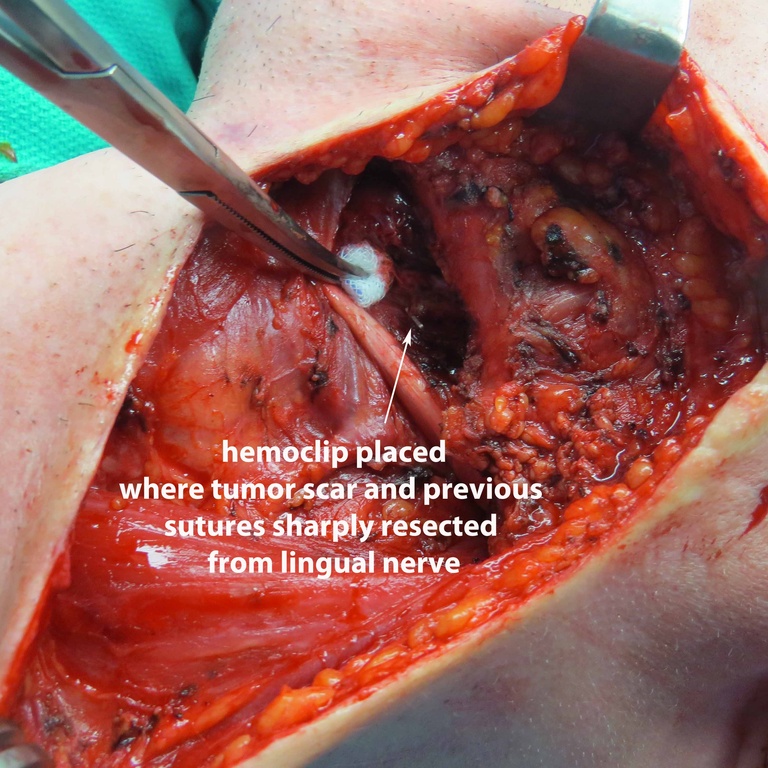 Extended Level I Neck Dissection