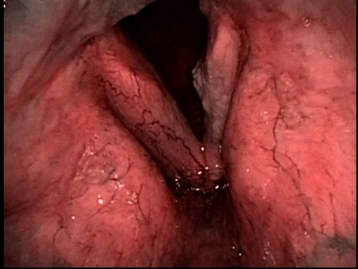 In clinic exam with High definition narrow band imaging