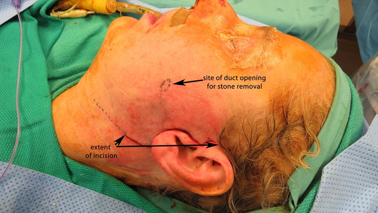 059 prior to suture placement.jpg