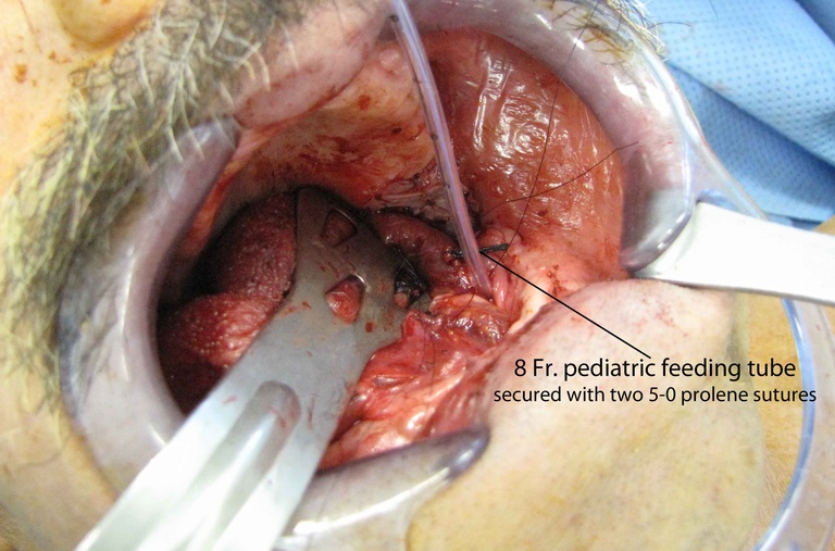 05ductoplasty%20e.jpg