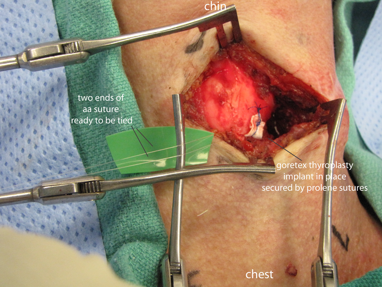 05implant in place.png