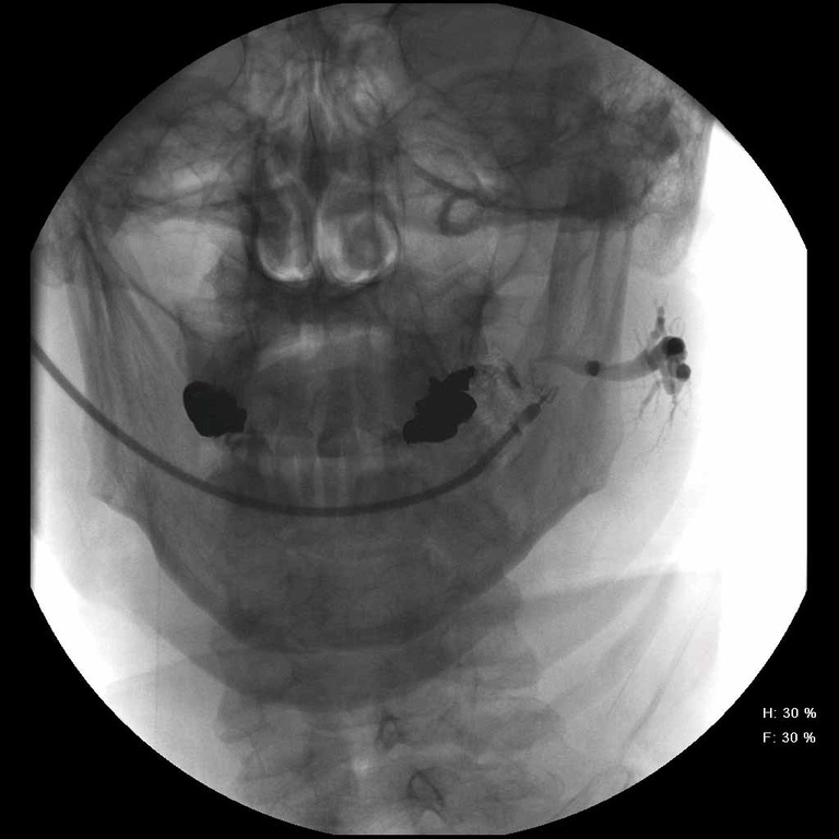 PA projection showing foreign body move back to mid-duct