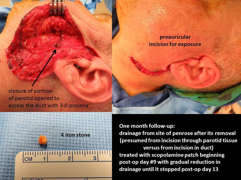 06%20open%20stone%20removal.jpg