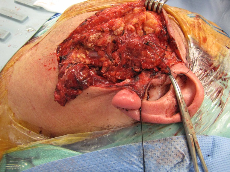 06%20parotid.jpg