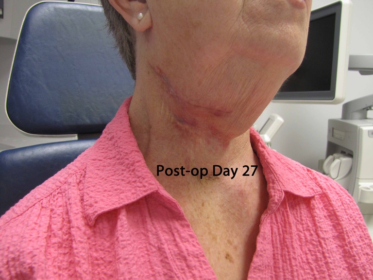 061%202nd%20arch%20excision%20postop.jpg