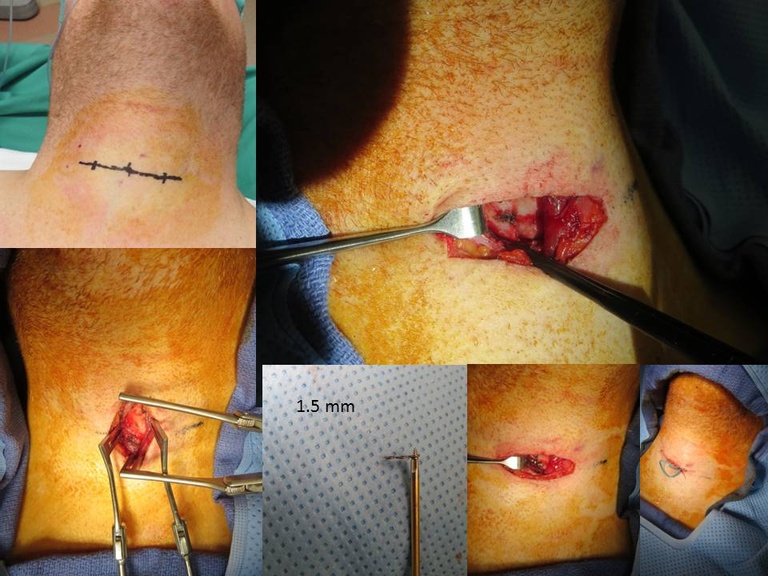 065%20collage%20intraop.jpg