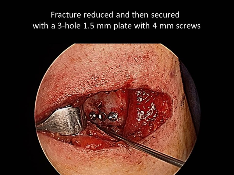 066%20intraop%20plate%20in%20place.jpg
