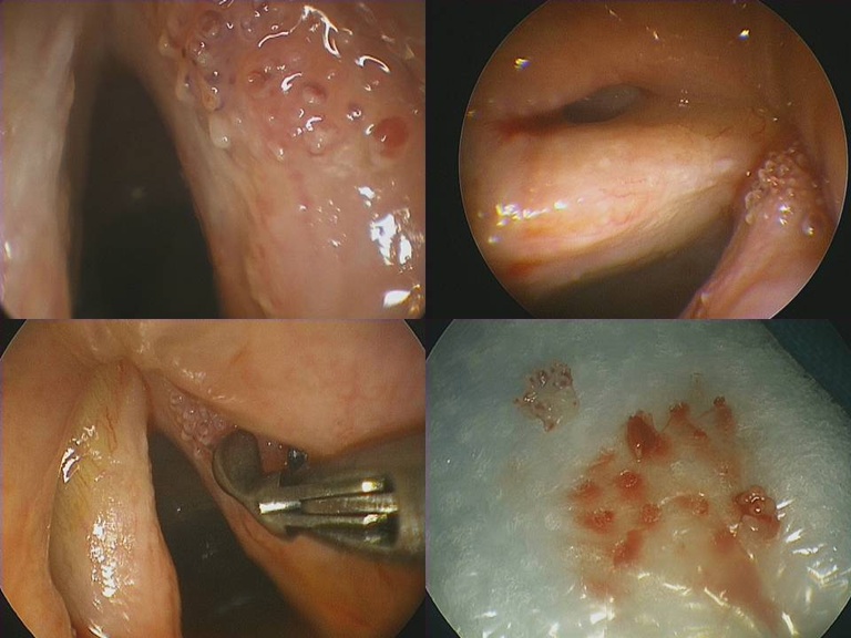 2011 Sept Microdirect laryngoscopy wtih biopsies