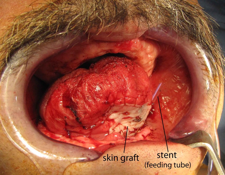 06ductoplasty%20f.jpg